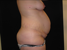 Tummy Tuck Before Photo by Jonathan Kramer, MD; Meridian, ID - Case 24364