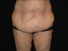 Tummy Tuck Before Photo by Jonathan Kramer, MD; Meridian, ID - Case 24365
