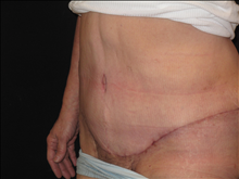 Tummy Tuck After Photo by Jonathan Kramer, MD; Meridian, ID - Case 24365