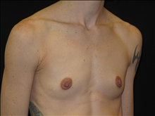 Breast Augmentation Before Photo by Jonathan Kramer, MD; Meridian, ID - Case 24419
