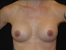 Breast Augmentation After Photo by Jonathan Kramer, MD; Meridian, ID - Case 24419