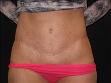 Tummy Tuck After Photo by Jonathan Kramer, MD; Meridian, ID - Case 24420