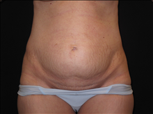 Tummy Tuck Before Photo by Jonathan Kramer, MD; Meridian, ID - Case 24420