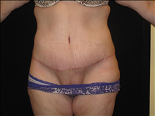 Tummy Tuck After Photo by Jonathan Kramer, MD; Meridian, ID - Case 24948