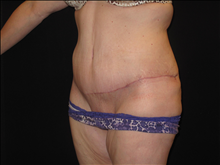 Tummy Tuck After Photo by Jonathan Kramer, MD; Meridian, ID - Case 24948
