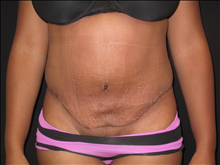Tummy Tuck After Photo by Jonathan Kramer, MD; Meridian, ID - Case 24949