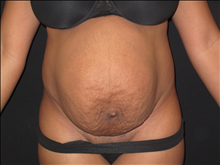 Tummy Tuck Before Photo by Jonathan Kramer, MD; Meridian, ID - Case 24949