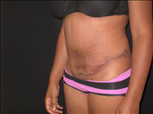Tummy Tuck After Photo by Jonathan Kramer, MD; Meridian, ID - Case 24949