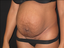 Tummy Tuck Before Photo by Jonathan Kramer, MD; Meridian, ID - Case 24949