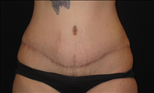 Tummy Tuck After Photo by Jonathan Kramer, MD; Meridian, ID - Case 24950