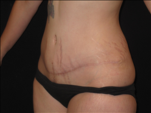 Tummy Tuck After Photo by Jonathan Kramer, MD; Meridian, ID - Case 24950
