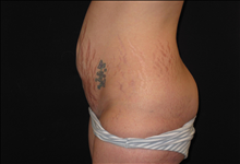 Tummy Tuck Before Photo by Jonathan Kramer, MD; Meridian, ID - Case 24950