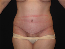 Tummy Tuck After Photo by Jonathan Kramer, MD; Meridian, ID - Case 24951