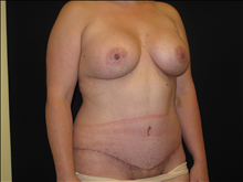 Tummy Tuck After Photo by Jonathan Kramer, MD; Meridian, ID - Case 24951