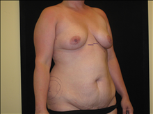 Tummy Tuck Before Photo by Jonathan Kramer, MD; Meridian, ID - Case 24951