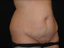 Tummy Tuck Before Photo by Jonathan Kramer, MD; Meridian, ID - Case 24951