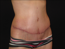 Tummy Tuck After Photo by Jonathan Kramer, MD; Meridian, ID - Case 24952