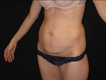 Tummy Tuck Before Photo by Jonathan Kramer, MD; Meridian, ID - Case 24952