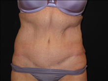 Tummy Tuck After Photo by Jonathan Kramer, MD; Meridian, ID - Case 24953