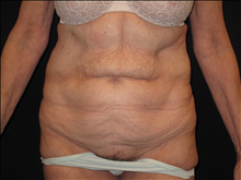 Tummy Tuck Before Photo by Jonathan Kramer, MD; Meridian, ID - Case 24953