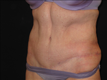 Tummy Tuck After Photo by Jonathan Kramer, MD; Meridian, ID - Case 24953