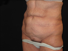 Tummy Tuck Before Photo by Jonathan Kramer, MD; Meridian, ID - Case 24953