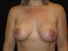 Breast Lift After Photo by Jonathan Kramer, MD; Meridian, ID - Case 24988