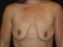 Breast Lift Before Photo by Jonathan Kramer, MD; Meridian, ID - Case 24988