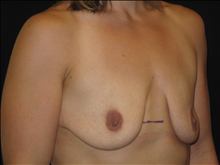 Breast Lift Before Photo by Jonathan Kramer, MD; Meridian, ID - Case 24988