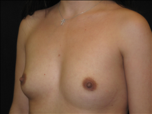 Breast Augmentation Before Photo by Jonathan Kramer, MD; Meridian, ID - Case 24989