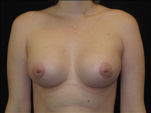 Breast Augmentation After Photo by Jonathan Kramer, MD; Meridian, ID - Case 25126