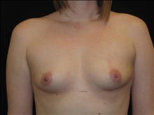 Breast Augmentation Before Photo by Jonathan Kramer, MD; Meridian, ID - Case 25126