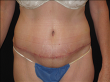 Tummy Tuck After Photo by Jonathan Kramer, MD; Meridian, ID - Case 25127