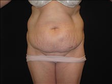 Tummy Tuck Before Photo by Jonathan Kramer, MD; Meridian, ID - Case 25127