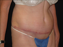 Tummy Tuck After Photo by Jonathan Kramer, MD; Meridian, ID - Case 25127