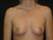 Breast Augmentation Before Photo by Jonathan Kramer, MD; Meridian, ID - Case 25157