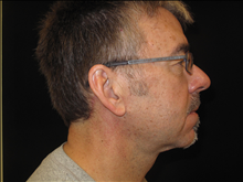 Facelift After Photo by Jonathan Kramer, MD; Meridian, ID - Case 25339
