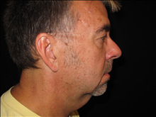 Facelift Before Photo by Jonathan Kramer, MD; Meridian, ID - Case 25339