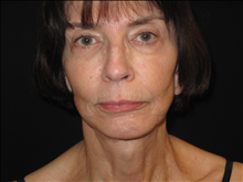Facelift After Photo by Jonathan Kramer, MD; Meridian, ID - Case 25340