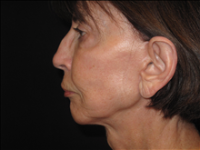 Facelift After Photo by Jonathan Kramer, MD; Meridian, ID - Case 25340