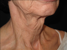 Facelift Before Photo by Jonathan Kramer, MD; Meridian, ID - Case 25340