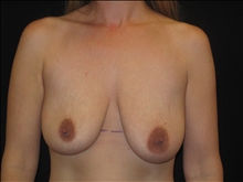 Breast Lift Before Photo by Jonathan Kramer, MD; Meridian, ID - Case 25455