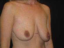 Breast Lift Before Photo by Jonathan Kramer, MD; Meridian, ID - Case 25455