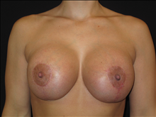Breast Lift After Photo by Jonathan Kramer, MD; Meridian, ID - Case 25457