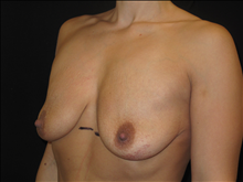 Breast Lift Before Photo by Jonathan Kramer, MD; Meridian, ID - Case 25457