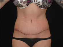 Tummy Tuck After Photo by Jonathan Kramer, MD; Meridian, ID - Case 25458