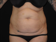 Tummy Tuck Before Photo by Jonathan Kramer, MD; Meridian, ID - Case 25458