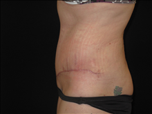 Tummy Tuck After Photo by Jonathan Kramer, MD; Meridian, ID - Case 25458
