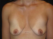 Breast Lift Before Photo by Jonathan Kramer, MD; Meridian, ID - Case 25629