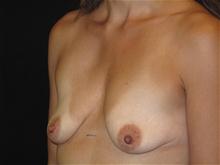 Breast Lift Before Photo by Jonathan Kramer, MD; Meridian, ID - Case 25629